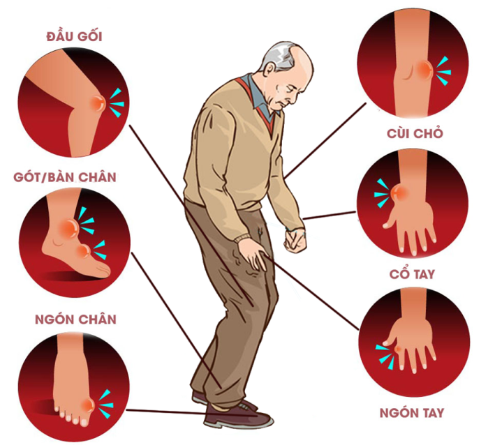 Cac dau hieu bi gout 1