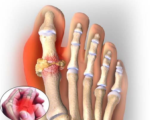 Cac dau hieu bi gout 2